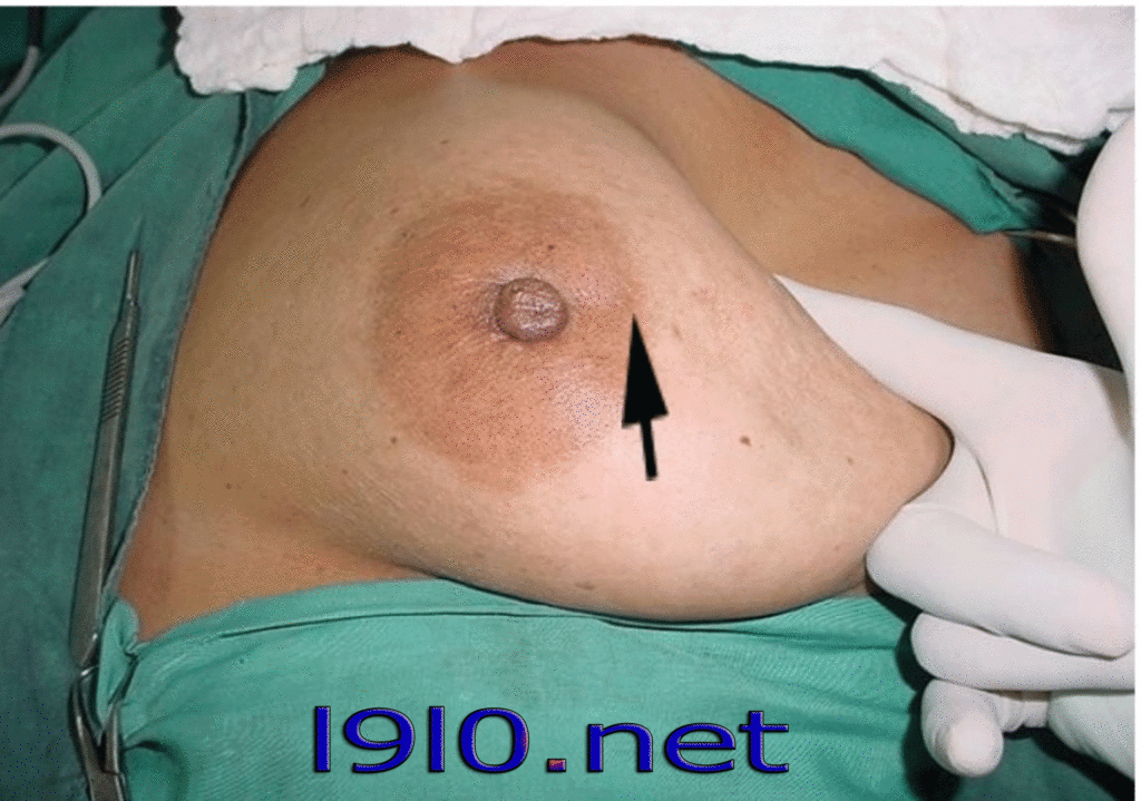علامات سرطان الثدي breast cancer ribbon